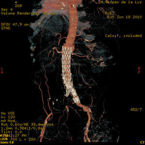 Angio-TAC con reconstrucción en 3D. Prótesis aorto-ilíaca «en Y» mostrando la existencia de fuga en la región superior protésica.