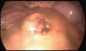 Masa abdominal en la raíz del mesenterio.