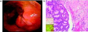 A) Imagen endoscópica del amiloidoma gástrico. Se observa una sobreelevación de la mucosa de gran tamaño, con ulceración profunda en su centro y bordes irregulares que pudiera confundirse con una úlcera gástrica maligna. B) Acumulaciones de material amiloide en forma de masas eosinófilas en la mucosa gástrica y la pared de los vasos. Se aprecia la tinción con rojo Congo (recuadro pequeño superior) con el amiloide en color anaranjado y la fluorescencia positiva con tioflavina T (recuadro inferior).