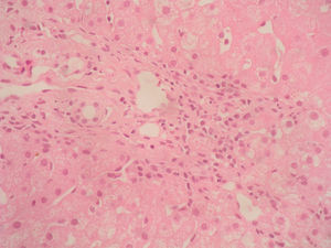 En esta imagen se aprecia, con mayor detalle, el infiltrado linfocitario (HE).