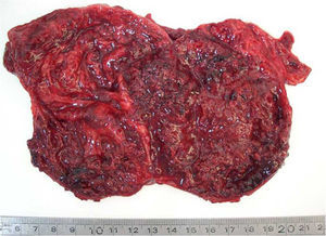 Macroscopía del tumor.