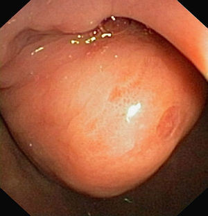 Lesión submucosa en bulbo duodenal, protruyente hacia la luz con erosión en su ápice.
