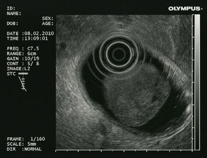 Lesión polipoidea duodenal bien definida y con una ecoestructura característicamente heterogénea.
