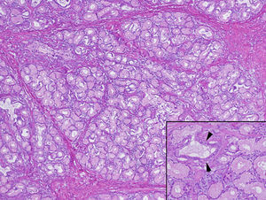 Pared intestinal recubierta por mucosa de tipo intestino delgado con fenómenos de autolisis y constituida por lóbulos de glándula mucosa con algunos conductos dilatados, separados por tractos de tejido conectivo y haces de músculo liso.