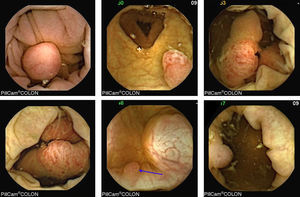 Imágenes de cápsula de colon Pillcam 2. Fuente Spada C et al3.