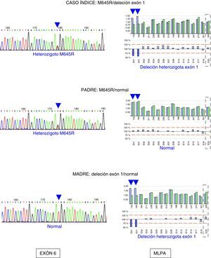 Estudio molecular del gen ATP7B en un paciente con enfermedad de Wilson y sus progenitores. A la derecha se muestra el electroferograma de parte de la secuencia exón 6 del gen ATP7B donde se encuentra localizada la mutación M645R: el caso índice y su padre son portadores de la mutación. A la izquierda se muestran los resultados del análisis por MLPA de los diferentes exones del gen, donde se detecta una deleción heterozigota del exón 1. El caso índice y su madre son portadores de dicha mutación.