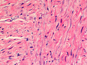 Proliferación mesenquimatosa de patrón fusocelular constituida por células fibroblásticas sin atipia citológica. (HE, X400.).