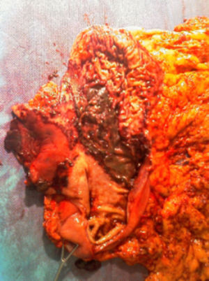 Imagen de la resección gástrica. Pieza de gastrectomía abierta donde se muestra gran ulceración ocupando principalmente la curvatura mayor de cuerpo gástrico.