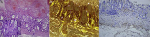 Imágenes de anatomía patológica de la resección gástrica. Imagen histológica que muestra la ulceración superficial de la mucosa gástrica (A) con depósitos de amiloide en la lámina propia (detalle), birrefringentes con dicroísmo verde manzana con la tinción de rojo Congo y luz polarizada (B) y teñidos con anticuerpos contra cadenas ligeras kappa (C).