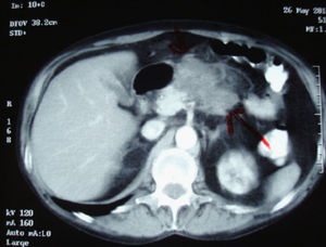 Tomografía abdominal. Masa en la cabeza pancreática.