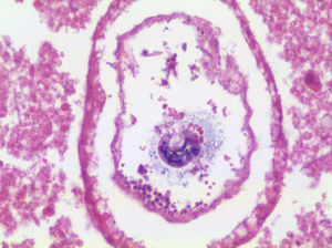 A gran aumento (40x), se aprecia la doble capa, irregular, con mamelones poco visibles externamente, con restos granulares en su interior (estructuras embrionarias de Ascaris). Huevo infértil o embrionado.