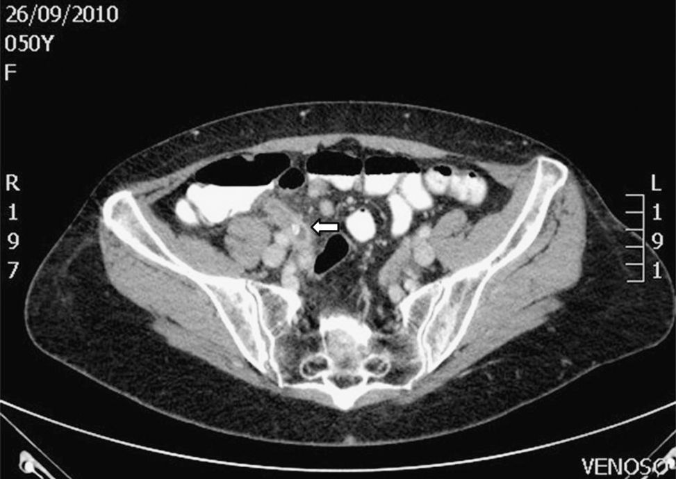 Apendicitis Aguda Posterior A Colonoscopia casualidad O Causalidad Apendicitis Aguda Posterior A Colonoscopia casualidad O Causalidad