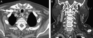 A) TC de cuello y tórax con cuerpo extraño de densidad calcio en el esófago (corte axial). B) Corte coronal.
