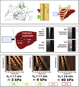 Características técnicas del FibroScan®.