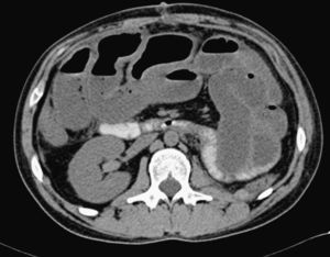TC abdominal en la que se observa dilatación de asas de delgado con niveles hidroaéreos en un paciente con enteritis por Clostridium difficile.