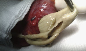 Retirada de seudomembranas a través de la incisión sobre un asa intestinal en un paciente con enteritis por Clostridium difficile.