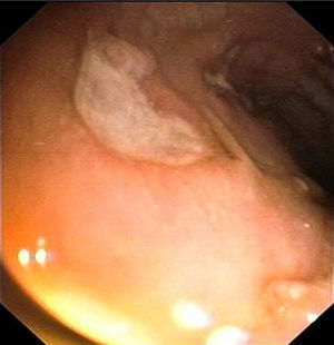 Colonoscopia que muestra afectación pancolónica con eritema y úlceras extensas y afectación ileal con eritema y úlceras.