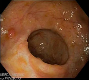 Colonoscopia de control en la que se aprecia mejoría de las lesiones endoscópicas con desaparición de las úlceras en colon y con una disminución de la afectación ileal.