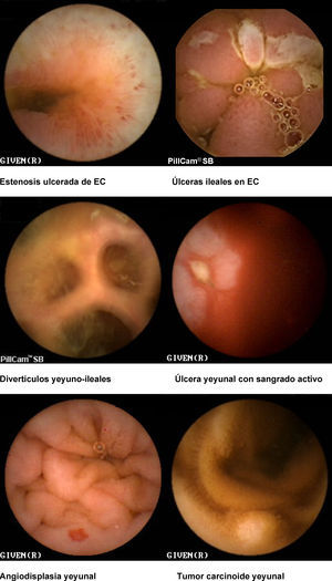 Imágenes de cápsula endoscópica. a) Estenosis ulcerada de EC. b) Úlceras ileales en EC. c) Divertículos yeyunoileales. d) Úlcera yeyunal con sangrado activo. e) Angiodisplasia yeyunal. f) Tumor carcinoide yeyunal.