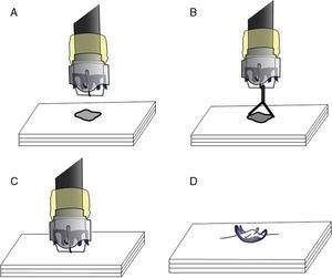 Aplicación del sistema OVESCO. A) Aproximación del endoscopio cargado con el sistema OVESCO a la perforación. B) Captura de los bordes de la perforación con las pinzas de aproximación. C) Introducción del tejido en el capuchón endoscópico. D) Liberación del clip OVESCO que captura el tejido y sella la perforación.