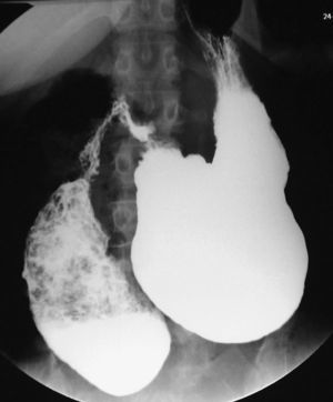 Imágenes de estudio esófago-gastroduodenal baritado demostrando dilatación de segunda porción duodenal e hipoperistaltismo.