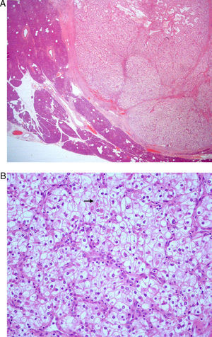El examen microscópico de la pieza quirúrgica mostró: A) Tinción H-E, 4x: páncreas normal, a la izquierda y nódulo metastásico, bien delimitado en la derecha. B) Tinción H-E, 20x: nidos de células claras propios de una metástasis de carcinoma de células renales. Algunas células tienen glóbulos hialinos en el citoplasma (flecha negra).