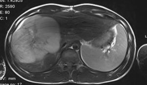 MRI showed a 15cm heterogeneous hepatic tumour with a necrotic central area.
