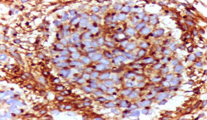 Histology: malignant, small round blue cell tumour, positive for CD99 (membrane staining).