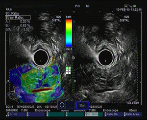 Estudio elastográfico cuantitativo de un paciente con cambios en la ultrasonografía endoscópica en modo B indicativos de pancreatitis crónica, que muestra un coeficiente de elasticidad del 3,03.