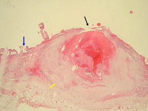 Lesión de Dieulafoy. Pared de arteria sangrante (flecha amarilla) y sitio de rotura (flecha negra) en interior de la pared de la vesícula (flecha azul). (HE, ×2,5).