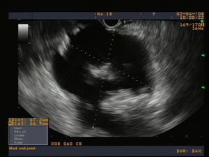 Imagen de un seudoquiste pancreático por ecografía endoscópica: en el interior de la cavidad quística puede observarse la presencia de material hiperecogénico correspondiente a detritos.