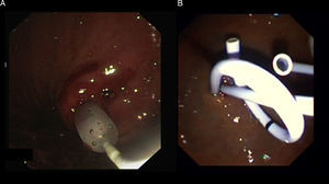Visión endoscópica: A) dilatación con balón del orificio de la cistogastrostomía; B) prótesis doble pigtailed in situ.