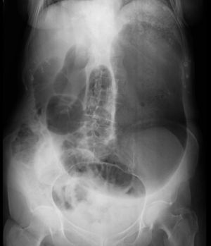 Radiografía de abdomen que muestra la dilatación esofágica y gástrica.