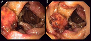 A y B. Lesiones nódulo-eritematosas en intestino delgado.