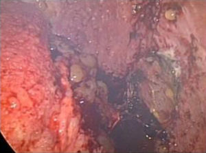 Imagen de la laparoscopia.