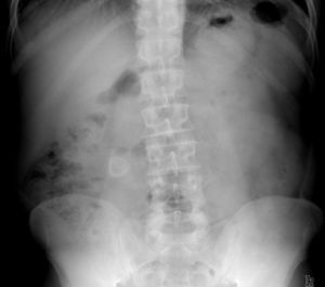 Radiografía simple de abdomen que muestra imagen de densidad cálcica con centro radiolúcido en la luz colónica.
