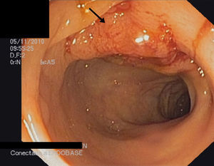 Lesión seudotumoral ulcerada vista por colonoscopia que las biopsias informaron de carcinoma neuroendocrino pobremente diferenciado.