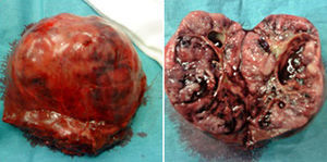 Pieza quirúrgica de tumor carcinoide hepático primario, bien delimitado con áreas de degeneración quística en su interior.