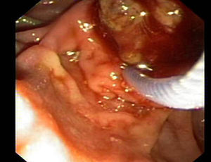 Endoscopic view of the lesions that were extracted using a Dormia-type basket.