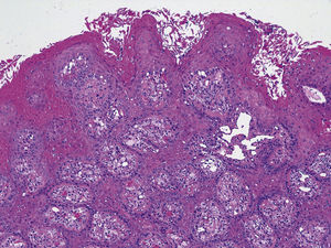 Panoramic view of the lesion showing papillomatosis, acanthosis, and marked brightly hyperparakeratosis. Ectatic vessels are focally present in the papilla (×100, hematoxylin and eosin).