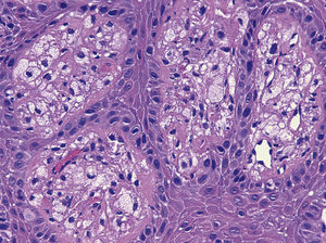 At higher magnification the lamina propia contains numerous foamy macrophages (×400, hematoxylin and eosin).