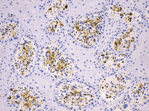 CD68 (KP1) showed strong cytoplasmic immunostaining in the xanthoma cells. The epithelial cells were negative (×200, immunohistochemical staining).