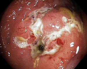 Estenosis inflamatoria colónica en un paciente con enfermedad de Crohn.