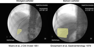 HVPG measurement with the “wedged” end-hole catheter and the balloon catheter. The volume of liver transmitting portal pressure is much larger (and thus less prone to artefacts) with the balloon catheter.