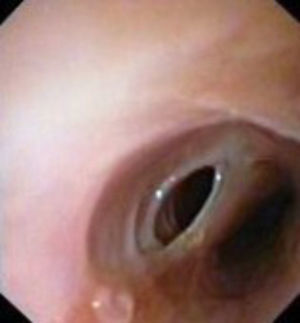 Endoscopy - At 12cm from dental arcade, a septum with.