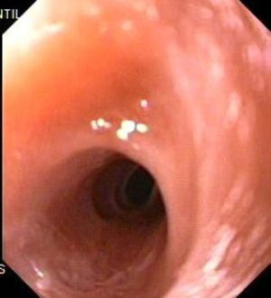 Several circumferencial regular esophageal stenosis.