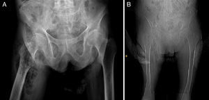 Radiografía simple. A) y B) Enfisema subcutáneo en raíz de muslo derecho.