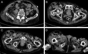 TC abdominopélvica. A) Afectación de los tejidos con origen en la musculatura lumbar hasta el músculo glúteo derecho. B) Afectación del canal inguinal derecho lateral al paquete vasculonervioso. C) y D) Afectación del tercio medio del muslo derecho rodeando el paquete vasculonervioso en su totalidad.