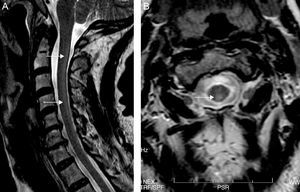 Sagittal (A) and axial (B) T2-weighted cervical MRI. Hyperintense image in the posterior half of the cervical cord from C2-C7 (arrows).