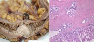 La pieza macroscópica muestra una lesión polipoide sésil de superficie blanquecina y de consistencia elástica y firme. En la imagen microscópica (HE, ×4) se observa epitelio intestinal con focos de endometriosis (glándula y estroma).